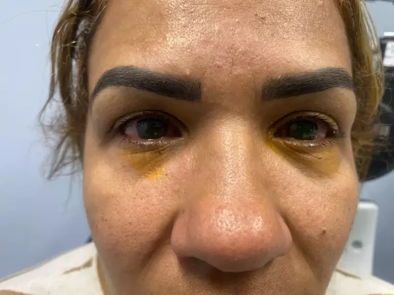 Empresária relata queimadura nos olhos após usar sérum da marca de Virgínia Fonseca